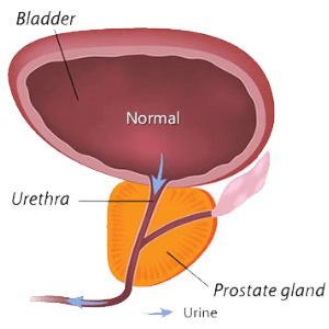 Prostate Problems